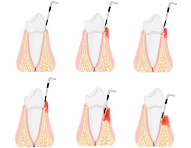 The Basic Periodontal Examination (BPE) Course For Dental Practice ...